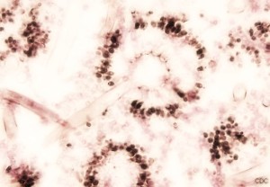 aspergillosi